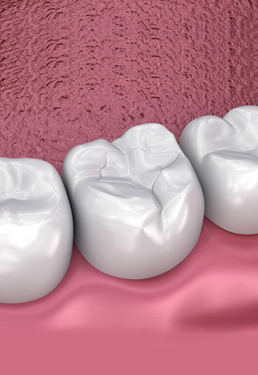 Three white dental crowns on pink gum model showing restorative dentistry treatment.