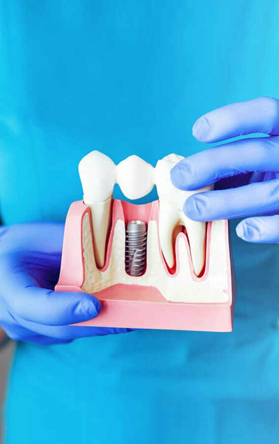 Dental professional holding model showing dental implant procedure against blue background.