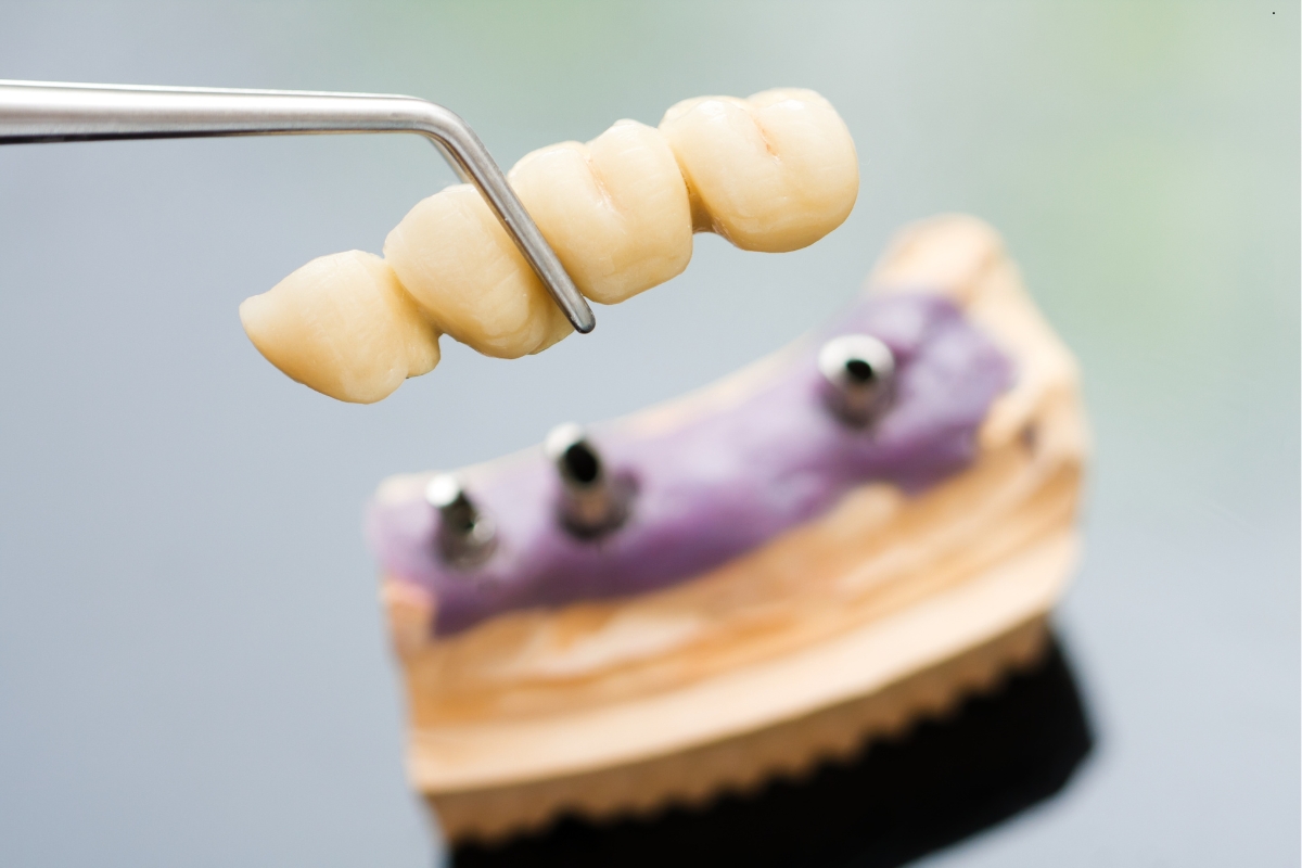Implant Supported Dentures in Van, TX