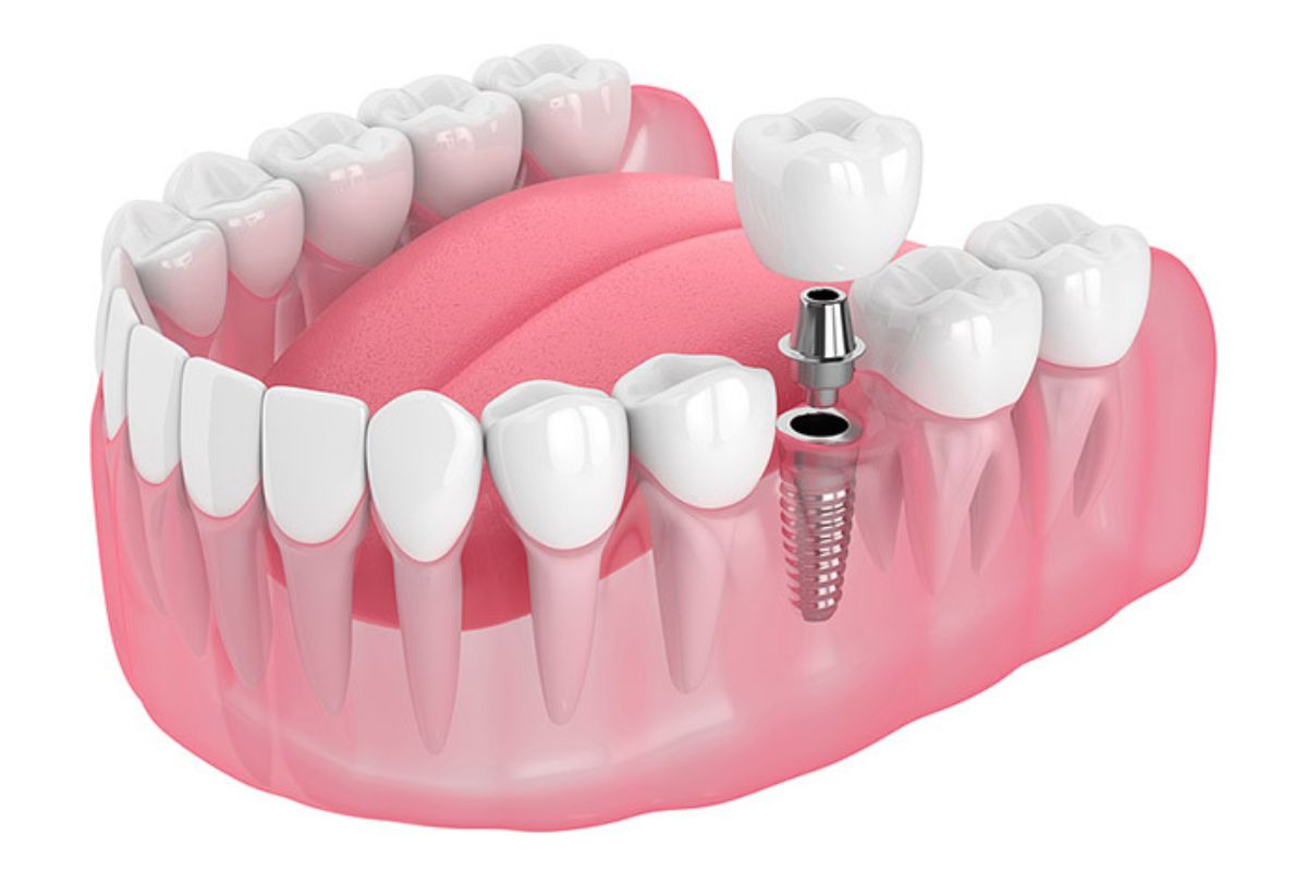 Dental Implants in Van