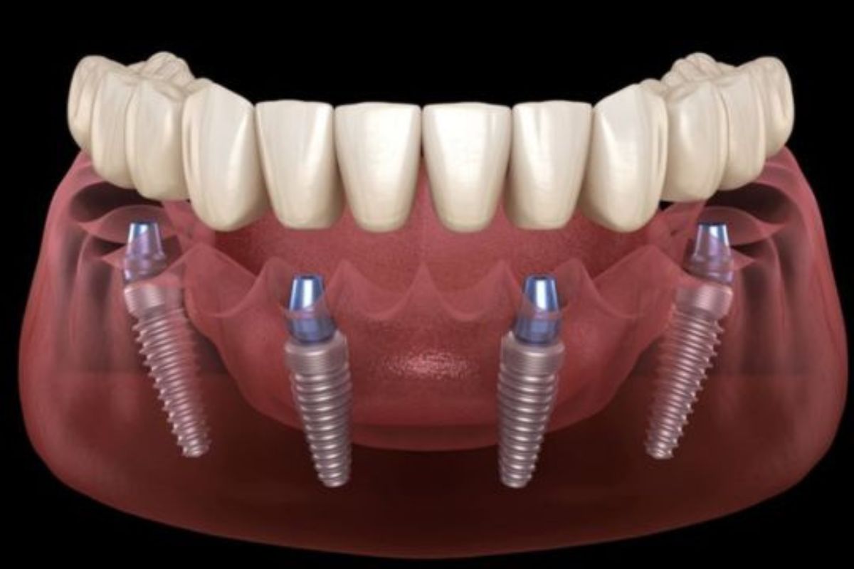 All-on-4 dental implants in Van