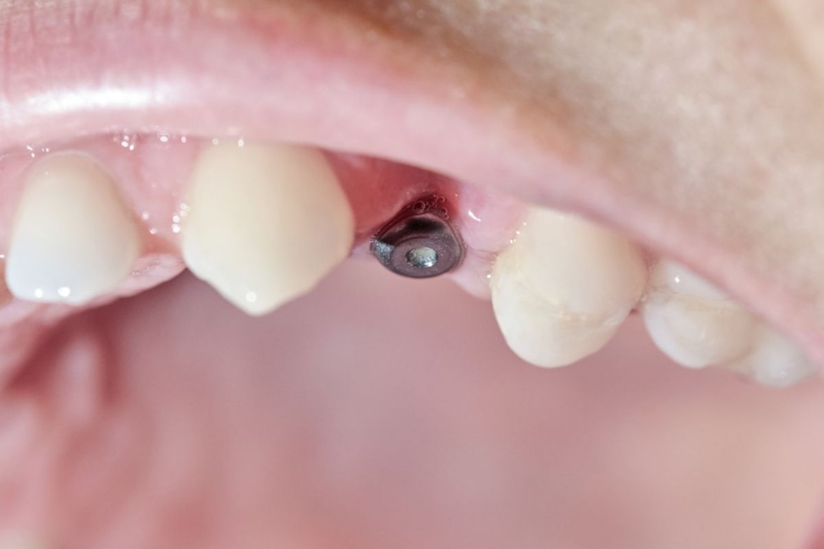 dental implants in Van