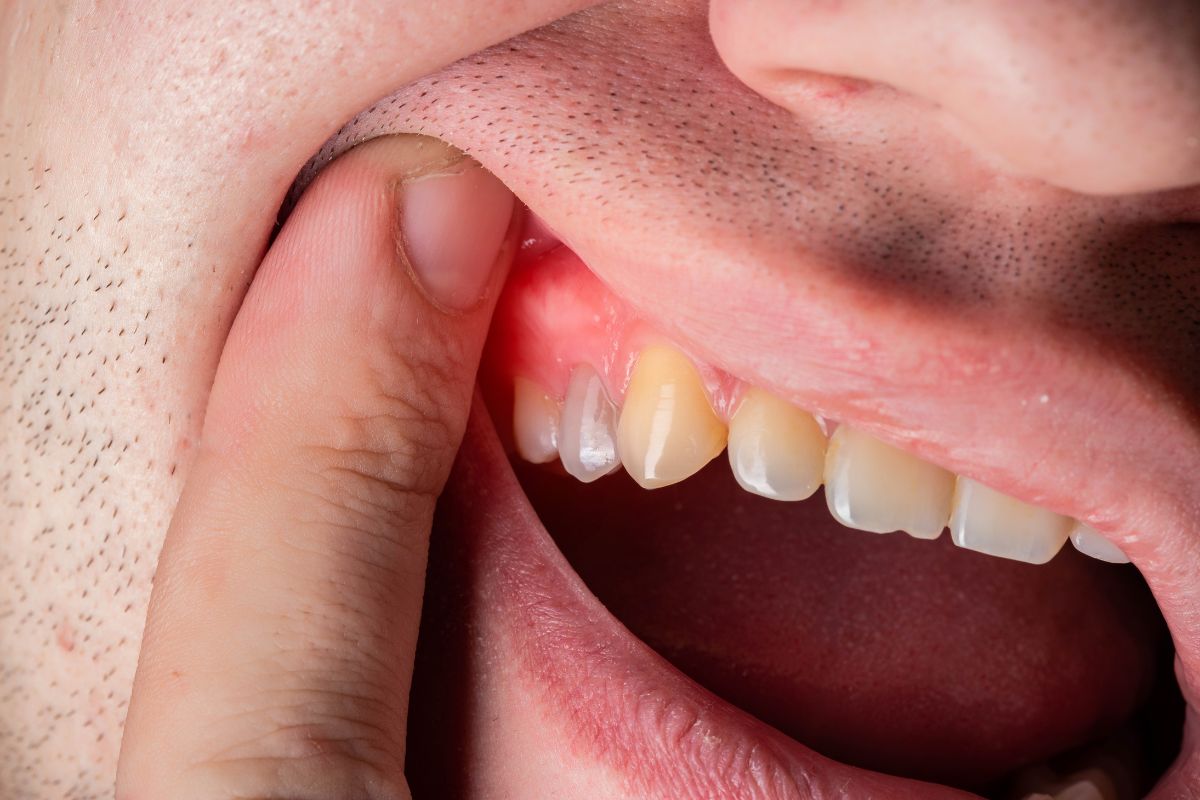 gingivectomy in Van