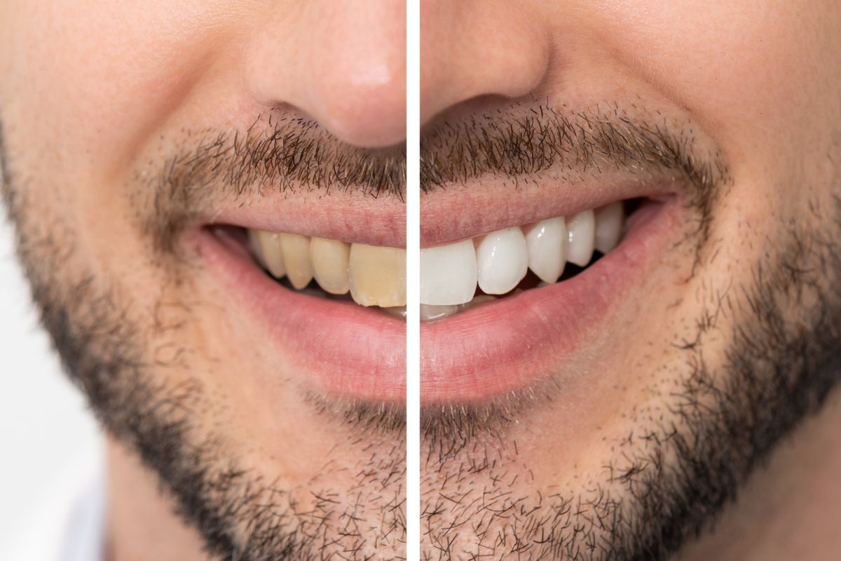 teeth whitening in Van