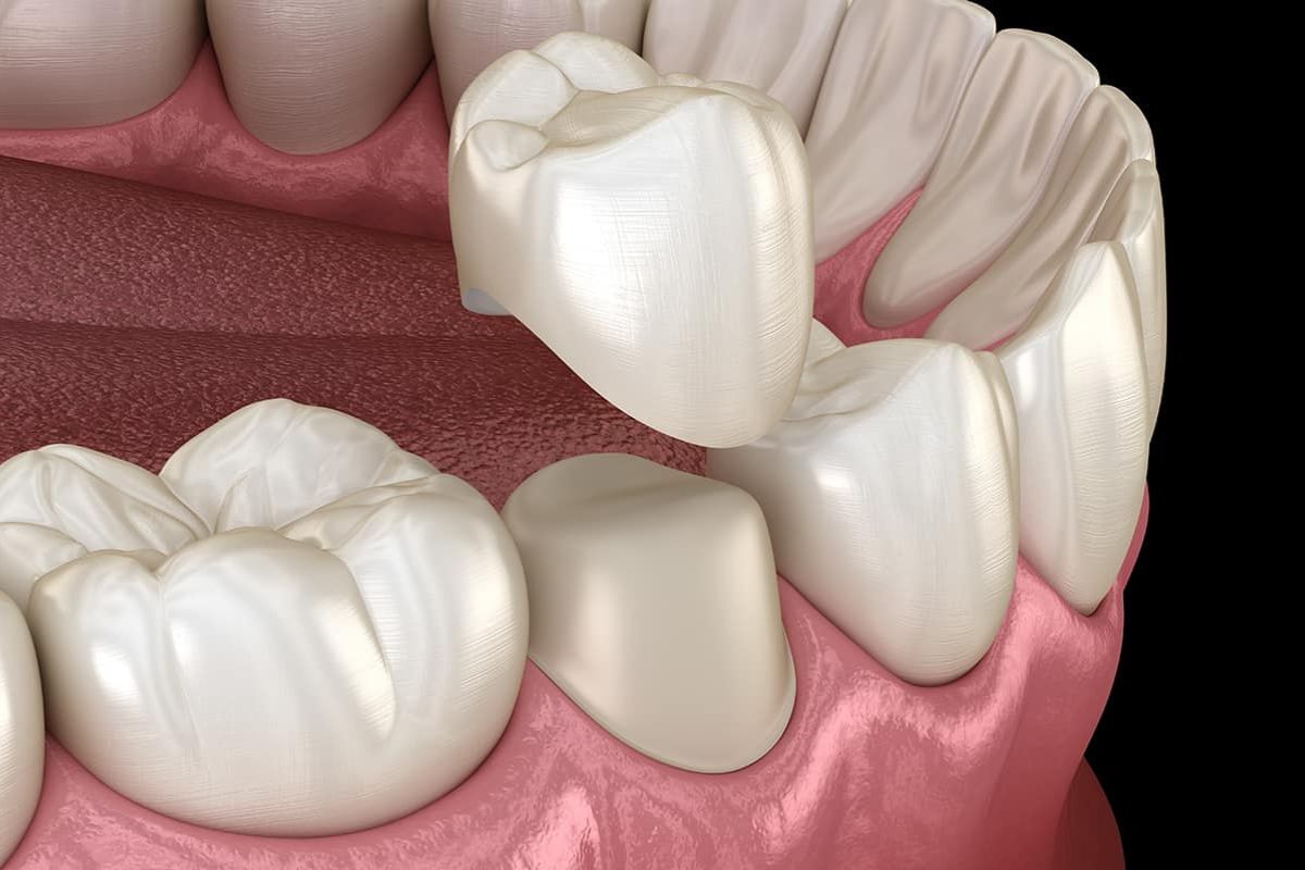 Dental Crowns Illustration