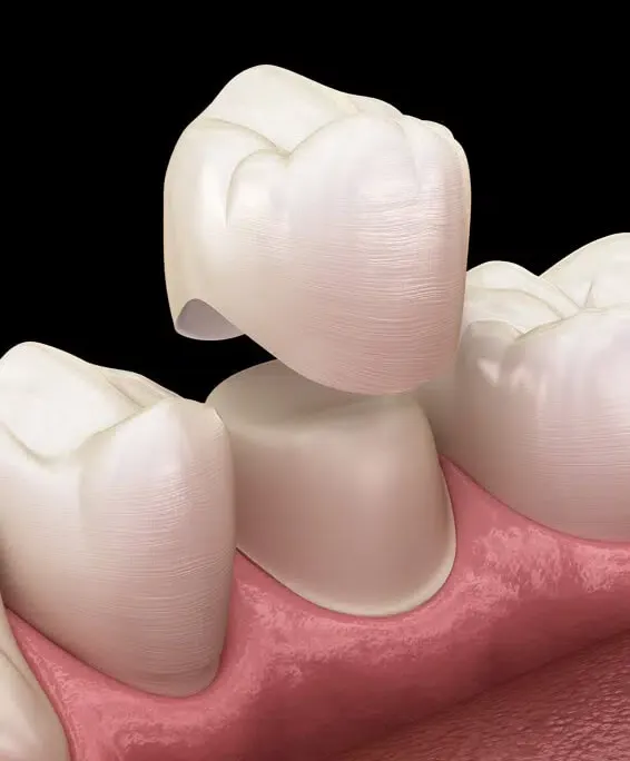 Dental crown restoration on model teeth showing ceramic crown placement over tooth preparation with pink gum tissue.