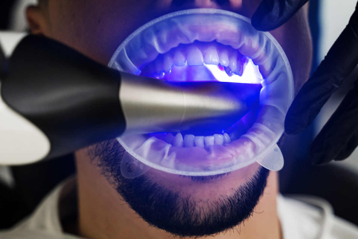 Teeth Whitening treatment