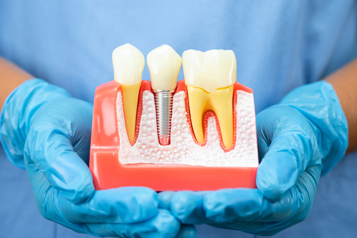 dental implants