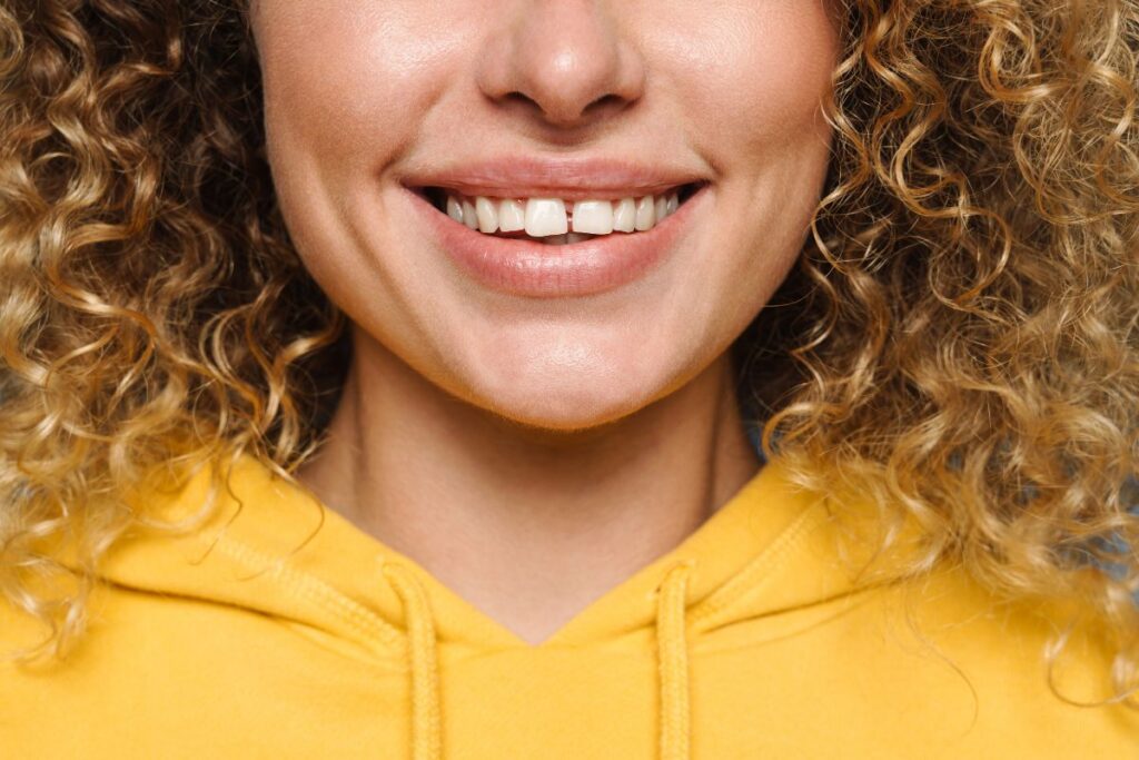 Cosmetic Bonding results showing a healthy smile after repairing chipped and uneven front teeth with tooth-colored composite resin.