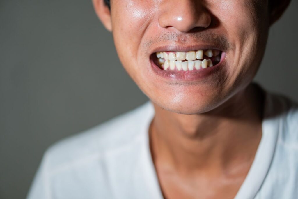 Person showing signs of teeth grinding and clenching with worn teeth
